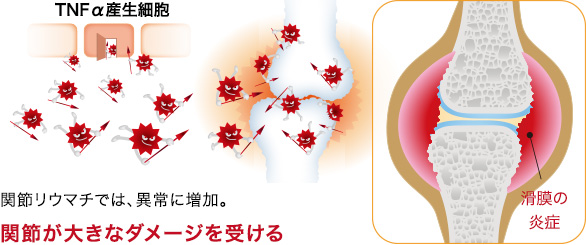 関節リウマチでは、異常に増加。関節が大きなダメージを受ける